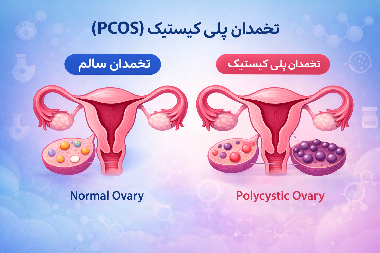 سندروم تخمدان پلی‌کیستیک (PCOS) یا تنبلی تخمدان چیست؟